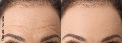 Woman before and after rejuvenating procedures. Collage with photos, closeup