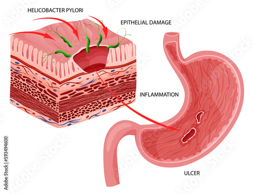 Stomach ulcer caused by helicobacter pylori infection.