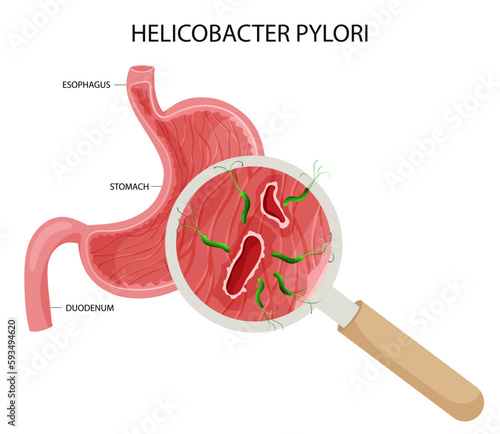 Helicobacter pylori in stomach ulcer