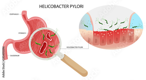 Helicobacter pylori infection in stomach ulcer under magnification.
