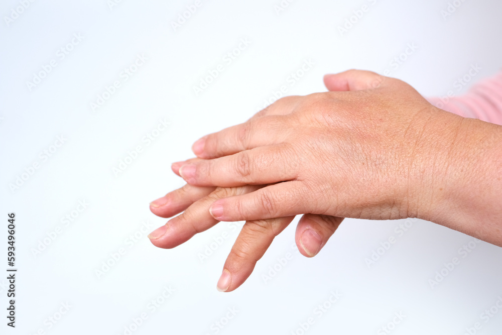 closeup female hands 55 years old with dry skin damage, applying moisturizer, concept care aging skin, treatment dermatological diseases, hydration and nutrition of epidermis, age-related skin changes closeup female hands 55 years old with dry skin damage, applying moisturizer, concept care aging skin, treatment dermatological diseases, hydration and nutrition of epidermis, age-related skin changes