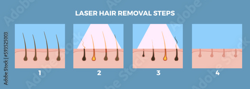 Laser hair removal and depilation steps infographic banner, vector illustration.