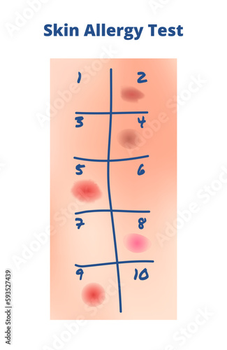 Vector illustration of skin allergy test isolated. Human skin with a microscopic amount of allergens and red spots or rash – reaction to an allergy. Skin prick, intradermic, scratch, or scrape test.