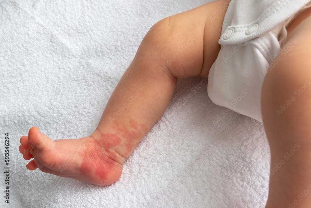 Hemangioma red birthmark on the leg of newborn baby Hemangioma red birthmark on the leg of newborn baby