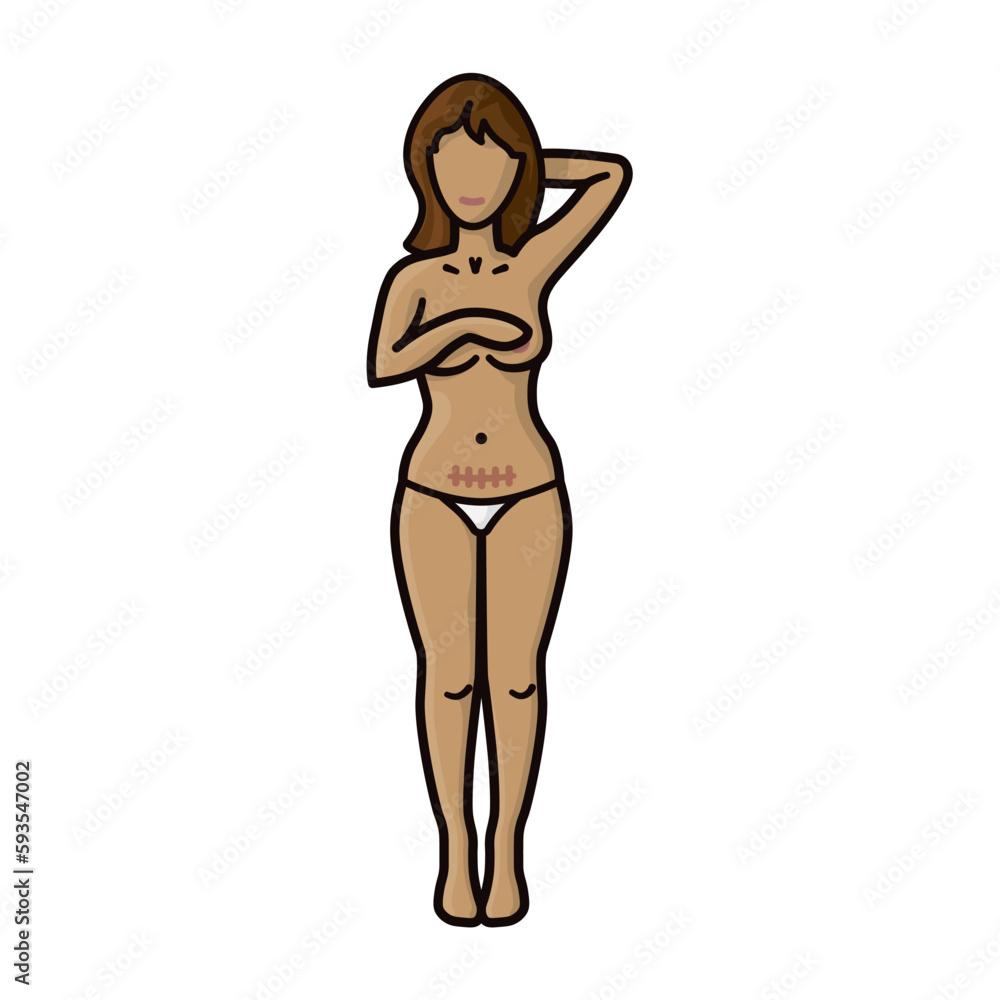 Semi nude woman with cesarean section scar isolated vector illustration for Cesarean Section Day on January 14