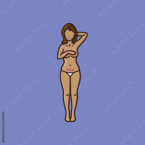 Semi nude woman with cesarean section scar vector illustration for Cesarean Section Day on January 14