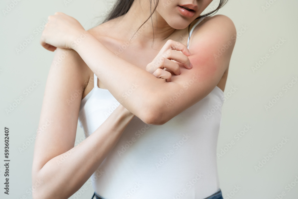 Dermatology, asian young woman reaction from atopic, insect bites on her arm, hand in scratching itchy red spot or rash of skin. Healthcare, treatment of beauty. Dermatology, asian young woman reaction from atopic, insect bites on her arm, hand in scratching itchy red spot or rash of skin. Healthcare, treatment of beauty.