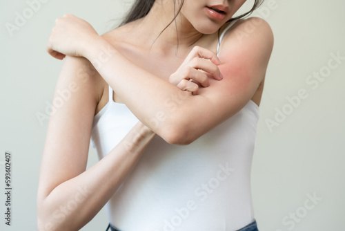 Dermatology, asian young woman reaction from atopic, insect bites on her arm, hand in scratching itchy red spot or rash of skin. Healthcare, treatment of beauty.