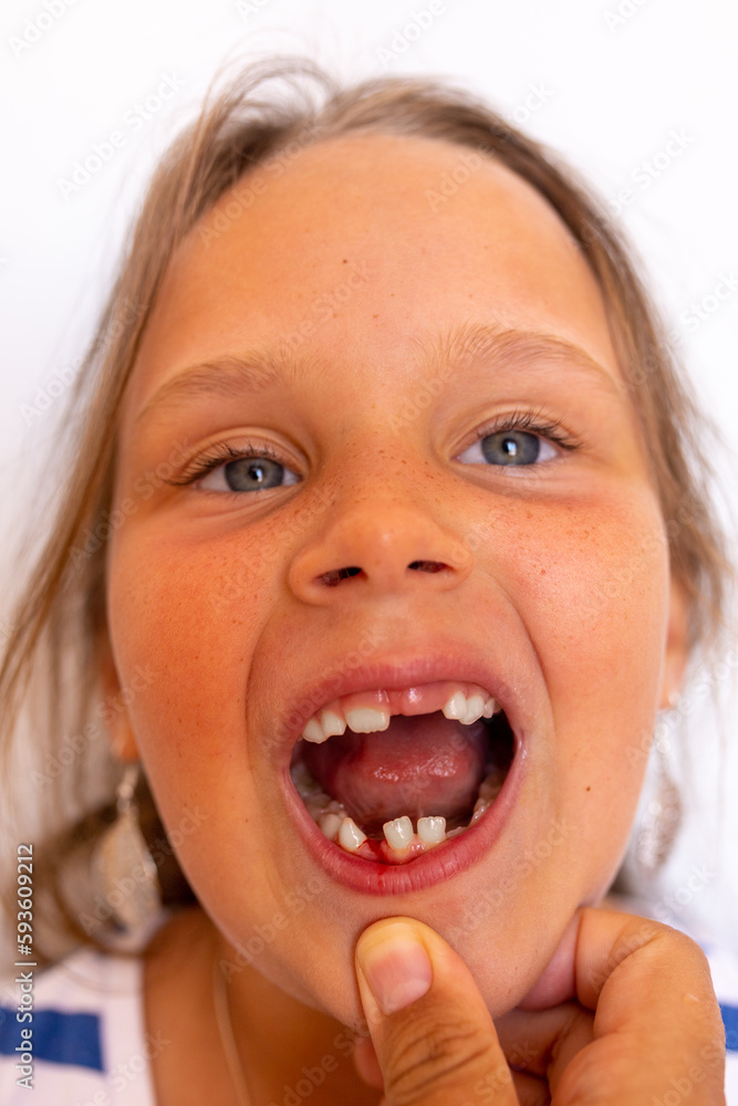 Vertical little girl with open toothless mouth, fresh wound bleeding