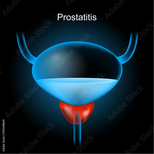 Prostatitis. Red Prostate gland and blue realistic bladder
