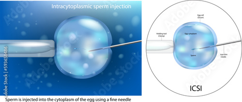 The procedure of Intracytoplasmic sperm injection ICSI. Artificial insemination in vitro fertilization. IVF macro. Scientific Diagram