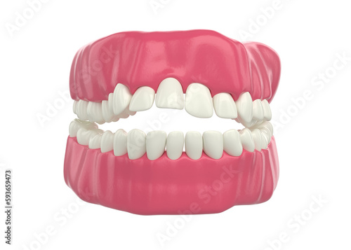 Crowded teeth, abnormal dental occlusion. 3D illustration for medically accurate teeth