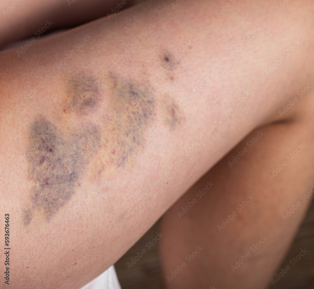 Naklejka premium Bruises on the leg of a female patient after a therapeutic massage, close-up.