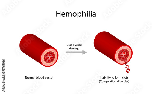 Hemophilia, a bleeding disorder that slows the blood clotting. Haemophilia (Coagulation disorder). Damaged blood vessel, hemorrhage. Healthy blood vessel after bleeding. Vector illustration.