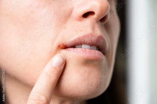 The woman with a virus herpes on lips. Herpes blisters. photo