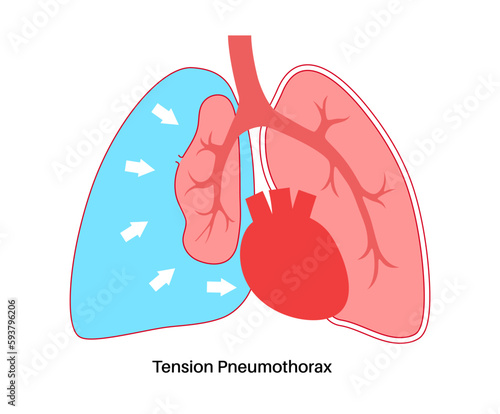 Tension pneumothorax poster