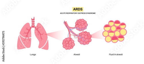 ARDS anatomical poster