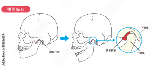 顎関節症の説明図
