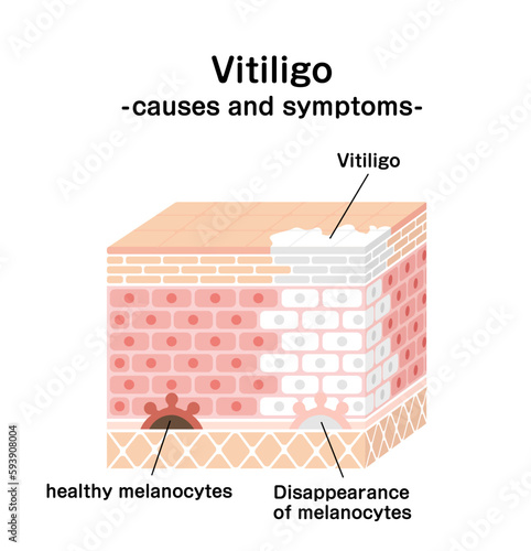 Causes and symptoms of Vitiligo vector illustration