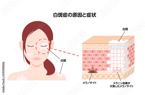 白斑(はくはん)の原因と症状イラスト (皮膚断面図図解)