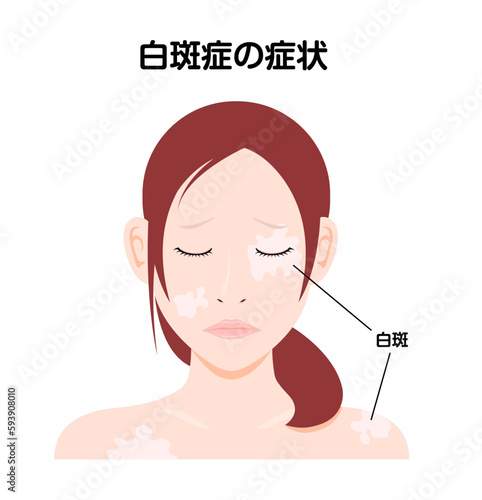 白斑(はくはん)の症状に悩む 若い女性イラスト