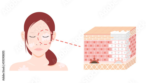 Causes and symptoms of Vitiligo vector illustration