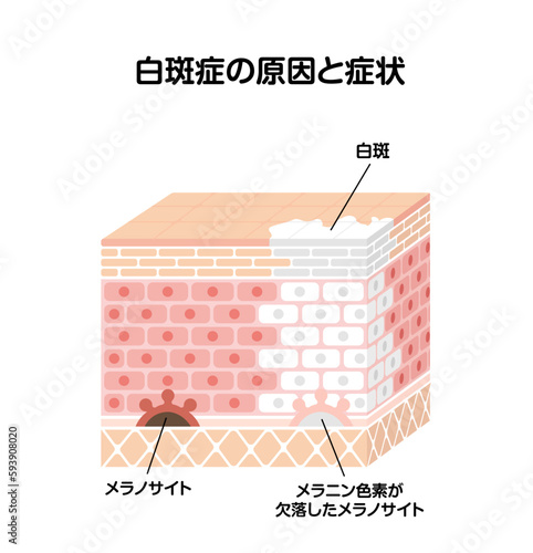 白斑(はくはん)の原因と症状イラスト (皮膚断面図図解) photo