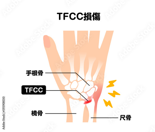 TFCC損傷 (三角線維軟骨複合体損傷) 図解ベクターイラスト