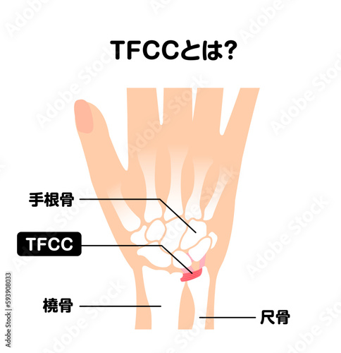 TFCC (三角線維軟骨複合体) とは？ 図解ベクターイラスト