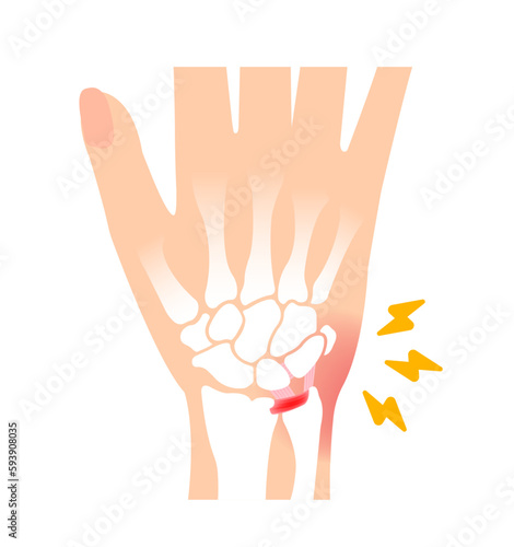 TFCC injury Vector illustration