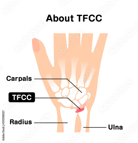 About TFCC  Vector illustration