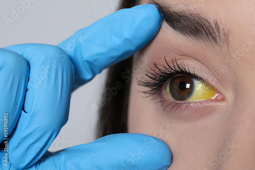 Doctor checking woman with yellow eyes on light background  closeup. Symptom of hepatitis