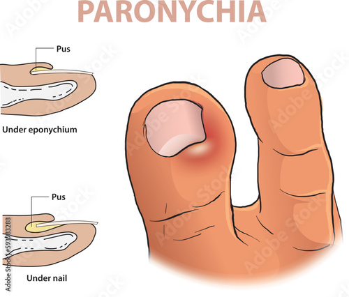 inforaphic illustration of paronychia in a toe  photo