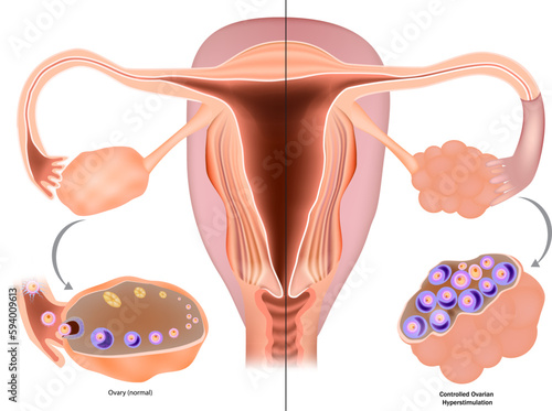 Controlled Ovarian Stimulation COS or Controlled ovarian hyperstimulation COH for IVF. Selecting the ideal protocol photo