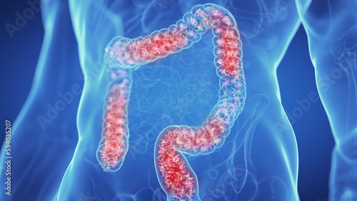 3d medical illustration of the microbiome of an inflamed colon