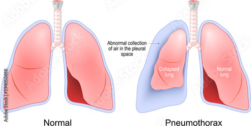 Pneumothorax. Normal, and collapsed lungs.