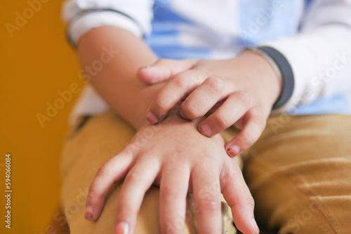  child girl suffering from itching skin on hand  © Towfiqu Barbhuiya 