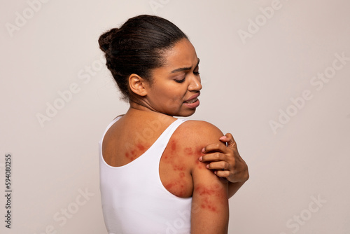 Black woman scratching red spots on her skin photo