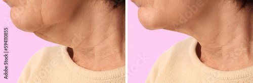 Foto Double chin problem