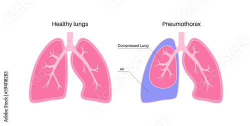 Pneumothorax anatomical poster