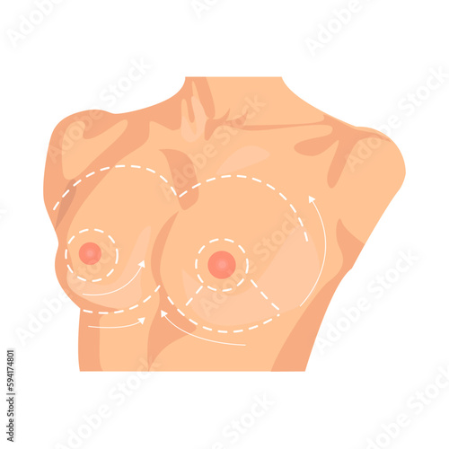 Breast lift illustration in color cartoon style. Editable vector graphic design.