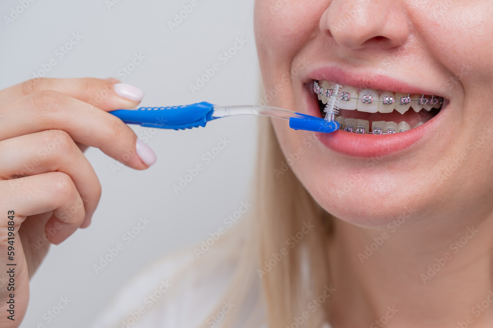 Caucasian woman cleaning her teeth with braces using a brush. Cropped portrait. Caucasian woman cleaning her teeth with braces using a brush. Cropped portrait.