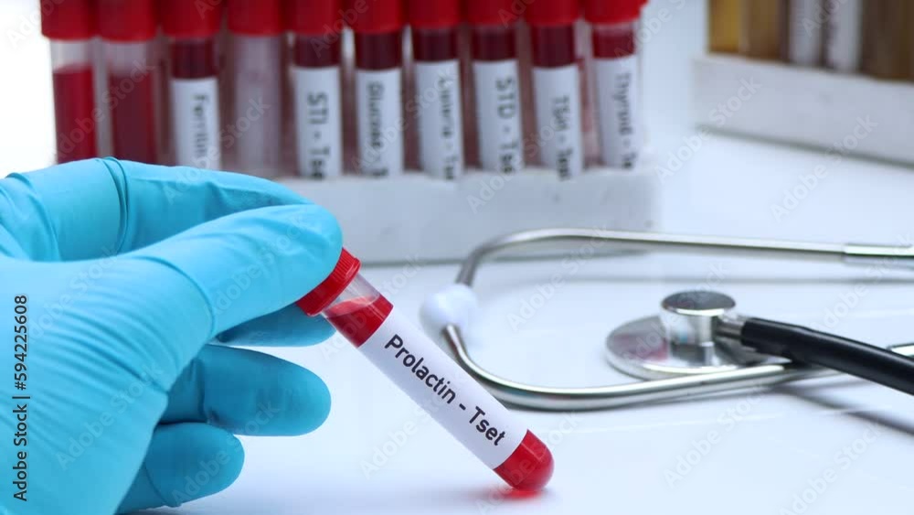 Vidéo Stock Prolactin test to look for abnormalities from blood, blood
