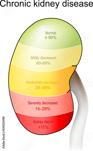 Chronic kidney disease. Stage of disorder