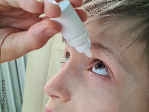 Treatment with therapeutic eye drops for child with conjunctivitis