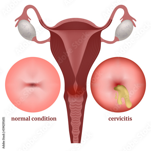 Inflammation of the cervix. Infographic showing the disease. Medical poster, vector illustration photo