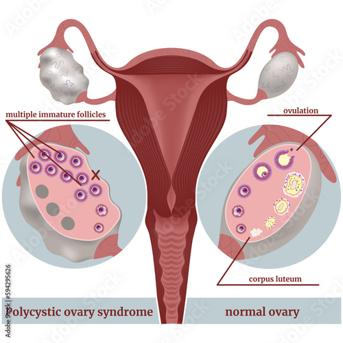 Polycystic ovary syndrome. Infographic showing the disease. Undeveloped follicles. Sectioned ovaries. Medical poster, vector illustration