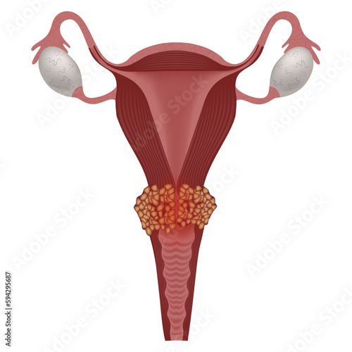 cervical cancer. Disease of the female reproductive system. Medical poster, vector illustration