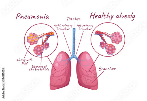 Concept Human anatomy organ lungs illness. The illustration depicts a flat, vector image of pneumonia-infected lungs. Vector illustration.