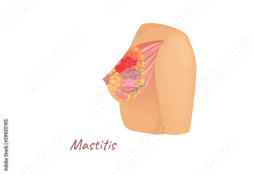 Concept Mammary glands female breast mastitis. This illustration depicts a flat, vector, cartoon-style design of the anatomy of the female breast. Vector illustration.